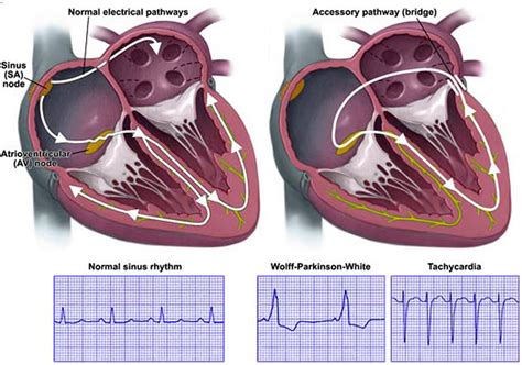 Uncovering Wolff-Parkinson-White Syndrome: A Rare Heart Problem