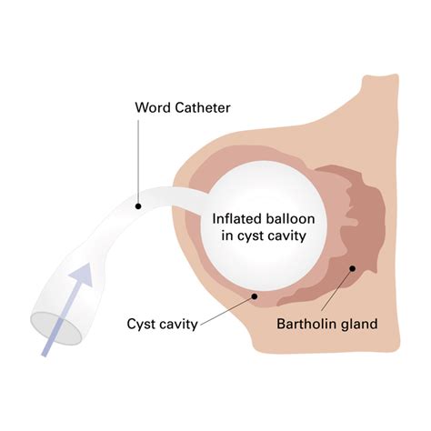5 Ways Catheterize