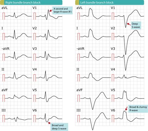 work up for rbbb