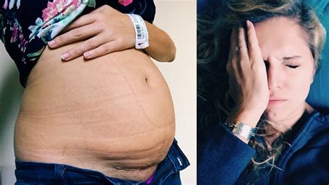 Working Out 2 Weeks After C Section