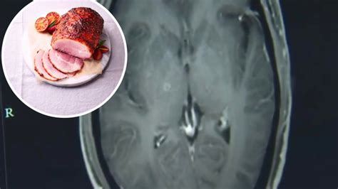 worms in brain from eating raw pork