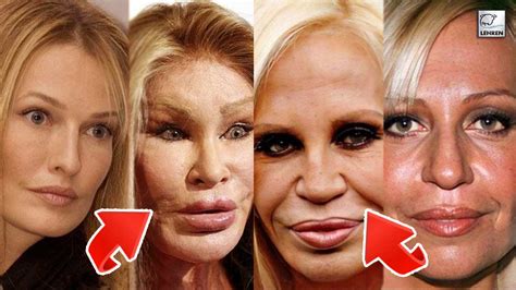 worst hollywood plastic surgeries