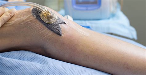 wound vac treatment for necrotizing fasciitis