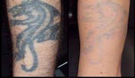 Wrecking Balm Tattoo Removal Before And After Get Rid Of