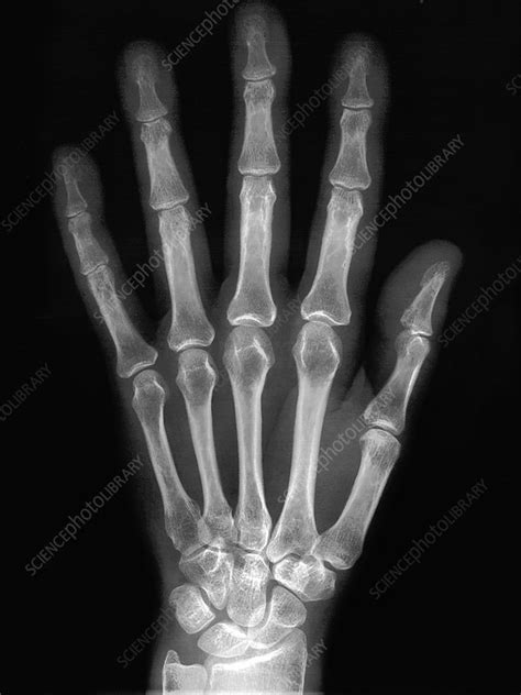 X Ray Normal Hand: Unveiling Subtle Signs You Didn't Know