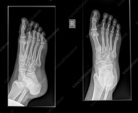 X Ray of Fractured Toe: Quick Diagnosis Guide