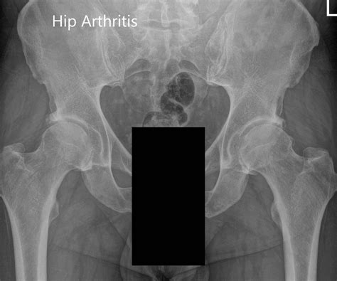 X Ray Of Left Hip Replacement