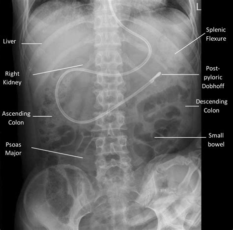 Understanding Stomach Health: The Role of X Ray of Stomach
