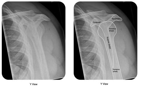 X Ray Shoulder Y View