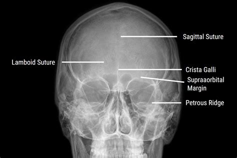 X Ray Sinus Labelled: Key Anatomy Guide