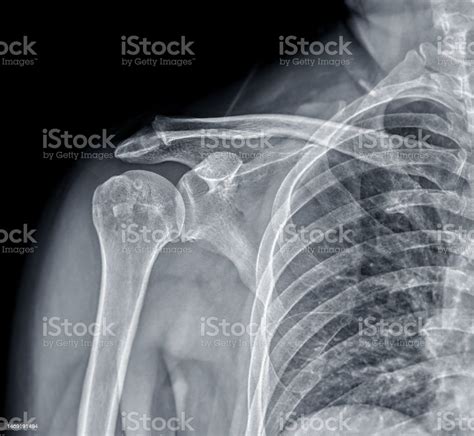 X Ray View For Shoulder