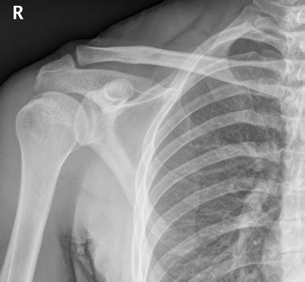 X-Ray Shoulder Ap