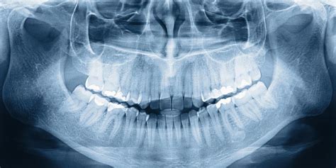 Factors Affecting the Cost of Dental X-Rays