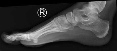 X-Rays Of A Foot