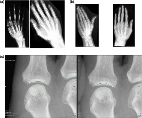 Xray Equipment Error