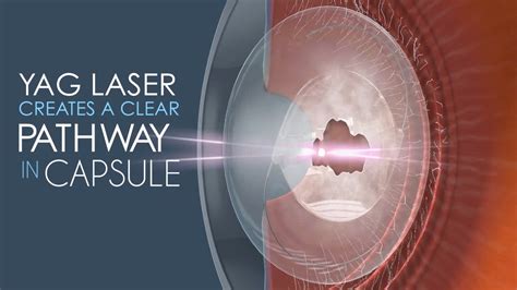 yag laser after cataract surgery procedure