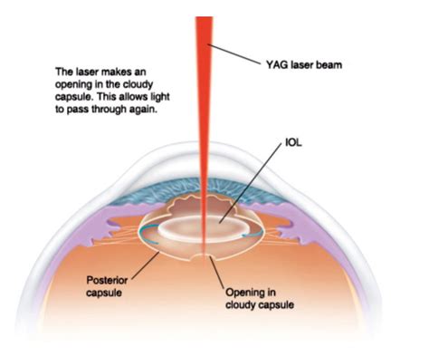 Clear Vision Restored: YAG Laser Capsulotomy Explained