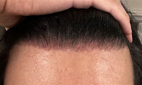 YAKER Hair Restoration + Med Spa (Joseph R. Yaker, MD) Reviews Read