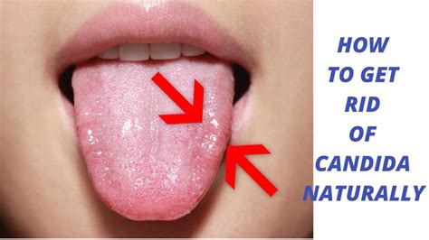 yeast infection on tongue images