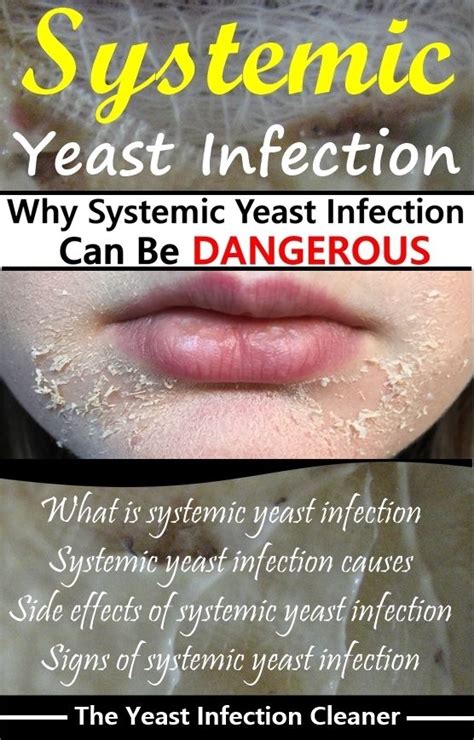 11 Highly Effective Home Remedies To Cure Yeast Infection