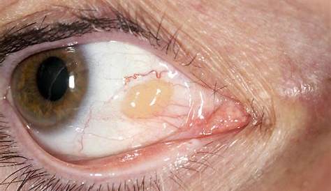 Yellow Fat On Eyeball Clear Bubble Renew Physical Therapy
