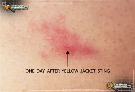 Yellow Jacket Bites Pictures: Identifying Symptoms and Reactions