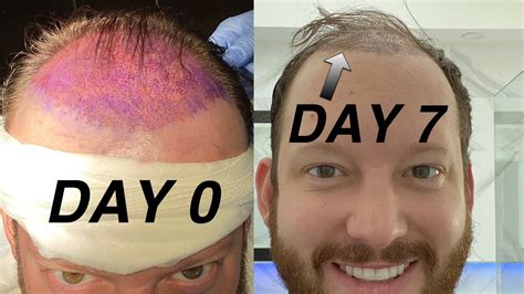 Receding Hairline? Find out how advanced hair restoration works