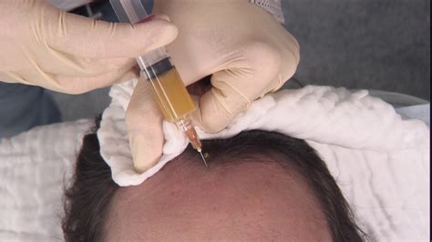 PRP Hair Restoration Treatment OxyBeauty YouTube