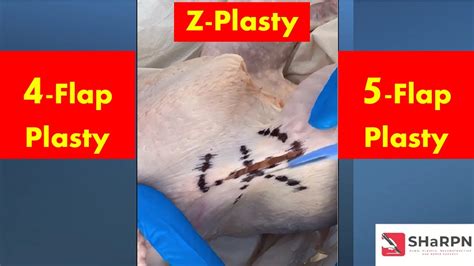 Z Plasty Flap Surgery