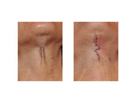 Z-Plasty Scar