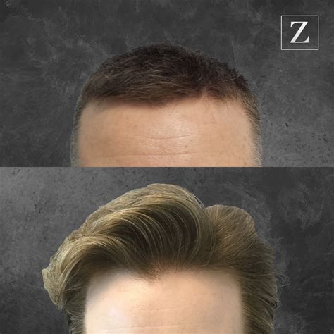 Male Hair Transplant Before and After Photos Ziering Medical