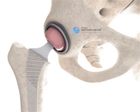 Zimmer Anterior Hip Replacement