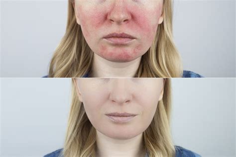 Zinc Chelate Rosacee