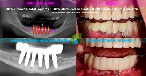 Zirconia Ceramic Implants