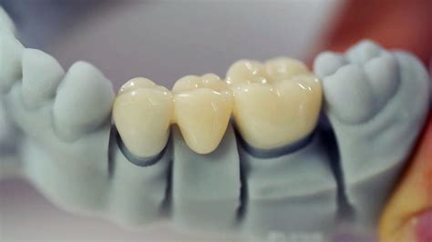 Zirconia Crown Ada Code