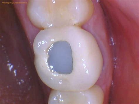 Zirconia Crown Root Canal