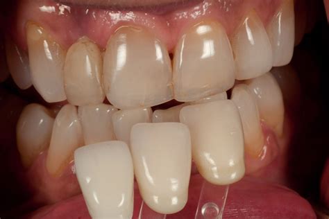 Zirconia Crown Shade Selection