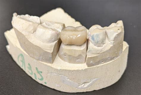 Zirconia Crown Too High
