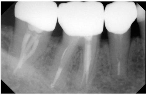 Zirconia Crown Xray