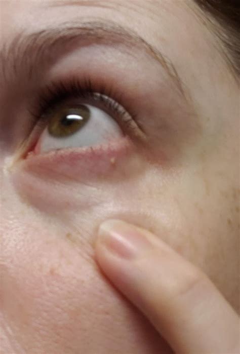 What to Do When You Get a Zit in Your Eye: Causes, Symptoms, and Effective Treatments