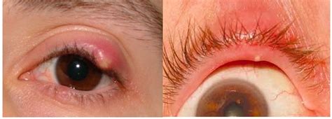 Zit Inside Eyelid: Causes, Symptoms, and Effective Treatments Revealed