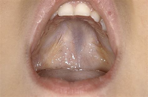 zona pellucida cleft palate