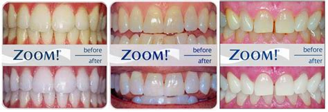 zoom teeth whitening cost