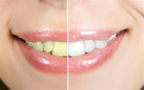 Zoom Whitening Doesn T Work