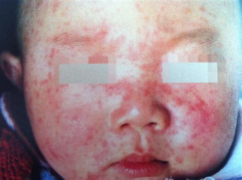麻疹的症状和图片